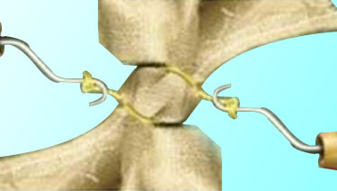 Manual Twisters for Bale Tying